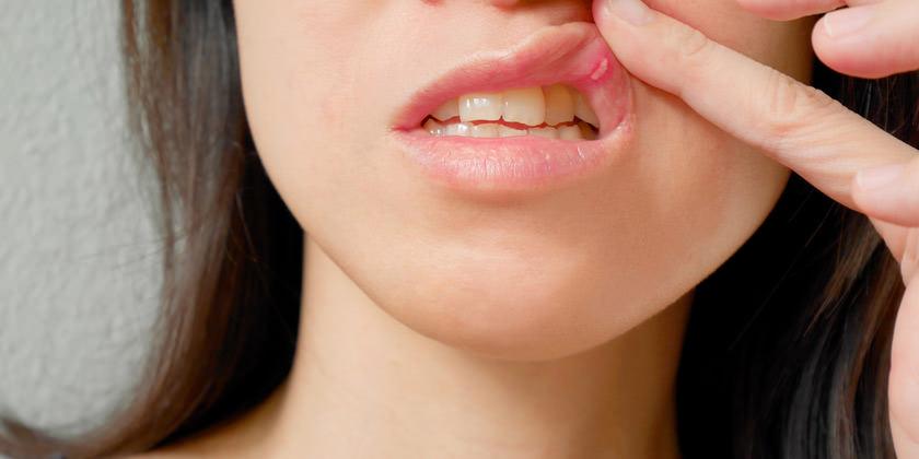 mujer con llagas en la boca 