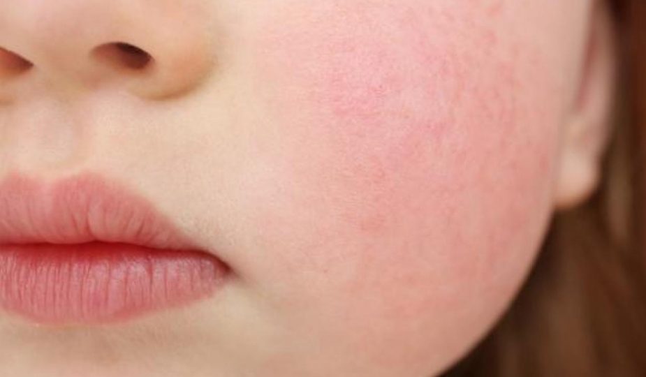 los brotes faciales y las alergias